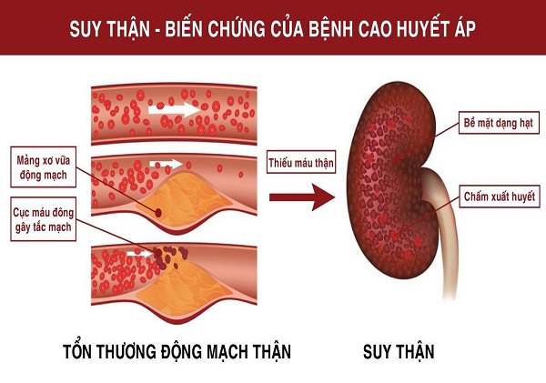 bệnh cao huyết áp